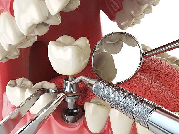 Best Knocked-Out Tooth (Avulsed Tooth) Treatment in Arnold, MD